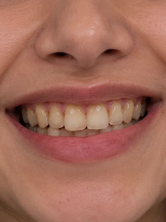 Complete Smile Makeover — before