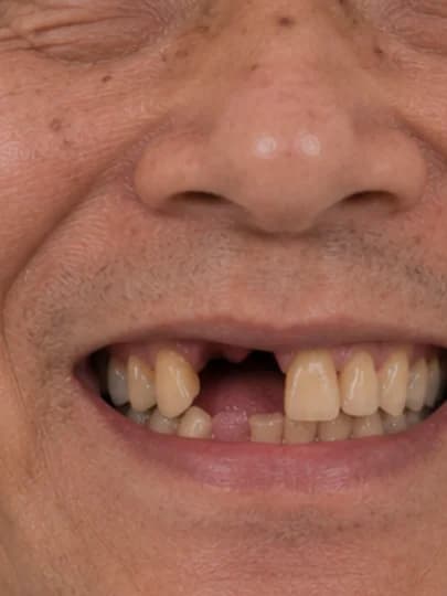 Dental Implant — before