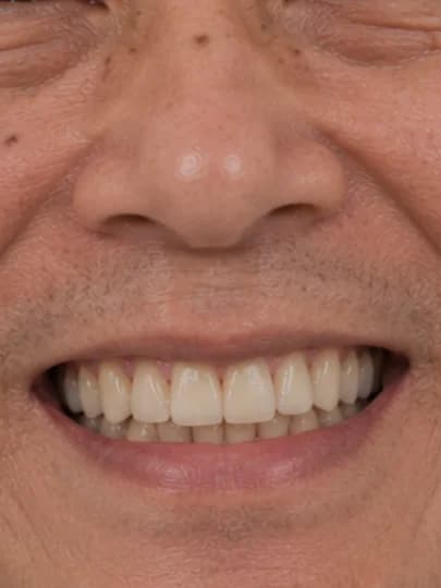 Dental Implant — after